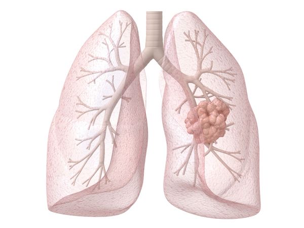 Le cancer broncho-pulmonaire