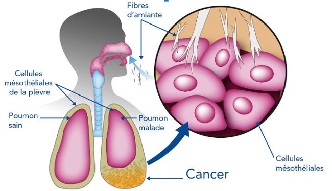 Représentation schématique du cancer de la plèvre (mesothéliome)